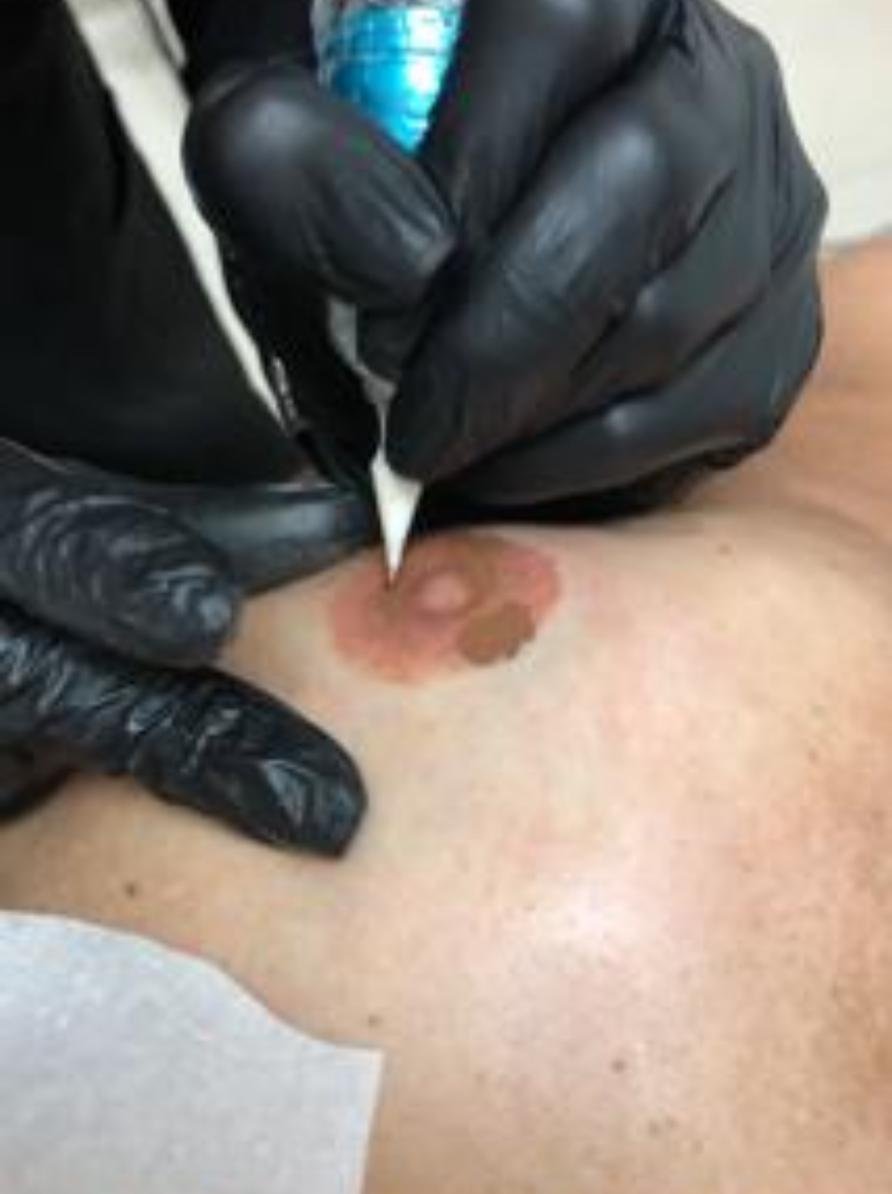 Tatuagem de aréola é oferecida gratuitamente no Outubro Rosa em Goiânia