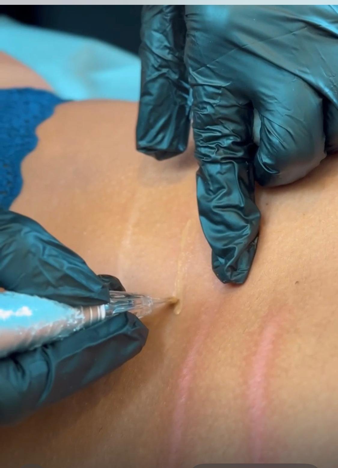 Camuflagem de estrias e cicatrizes devolve autoestima 