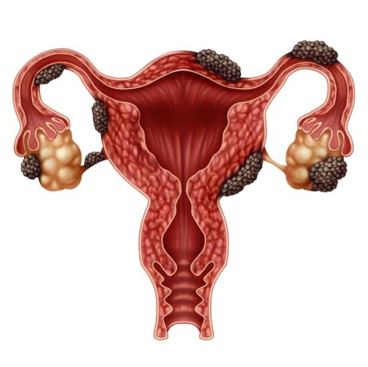Dor não é normal: Dia Internacional da Luta contra a Endometriose alerta para doença que afeta milhões de mulheres