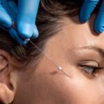 Fios de sustentação ganham espaço na estética facial com resultados naturais e recuperação rápida