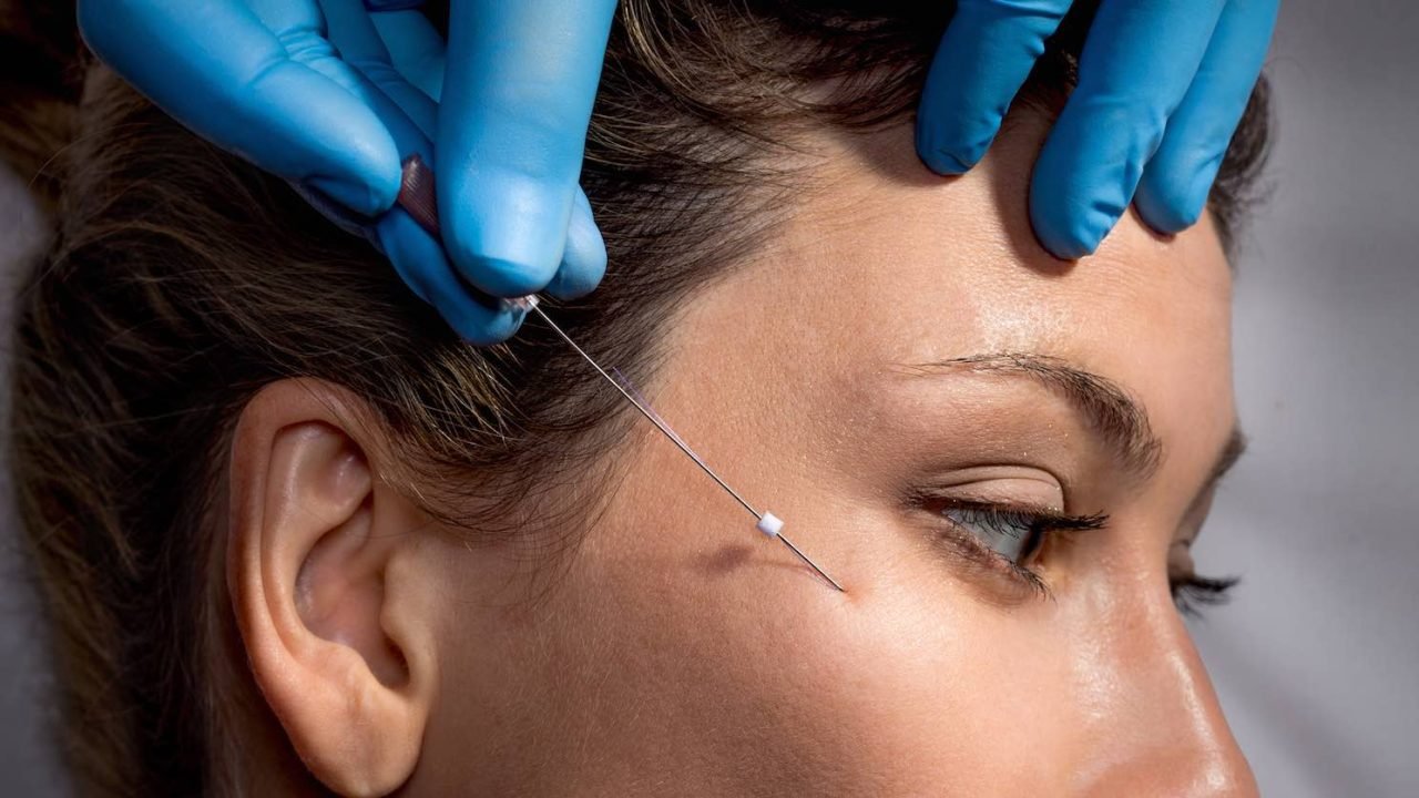 Fios de sustentação ganham espaço na estética facial com resultados naturais e recuperação rápida