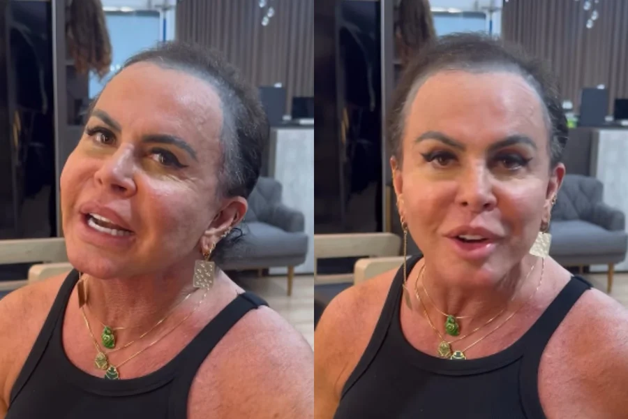 Gretchen revela técnica de transplante capilar usada para tratar a alopecia